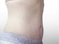 After Patient04 Right Atlanta Plastic Surgery - Top Doctor by Atlanta Magazine