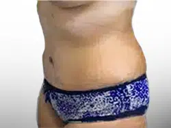 After Patient05 Left Atlanta Plastic Surgery - Top Doctor by Atlanta Magazine