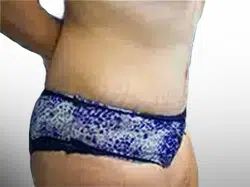 After Patient05 Right Atlanta Plastic Surgery - Top Doctor by Atlanta Magazine