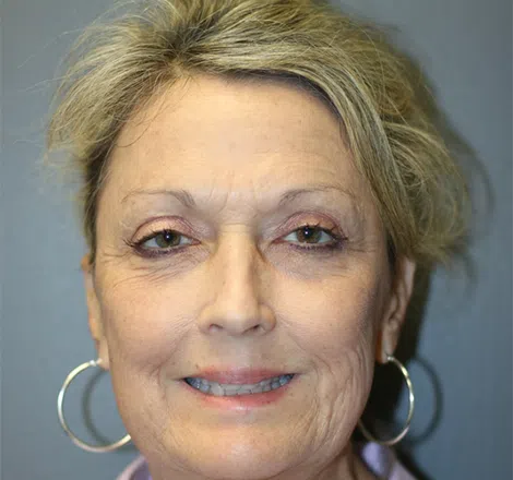 Before FLPatient01 Front Atlanta Plastic Surgery - Top Doctor by Atlanta Magazine