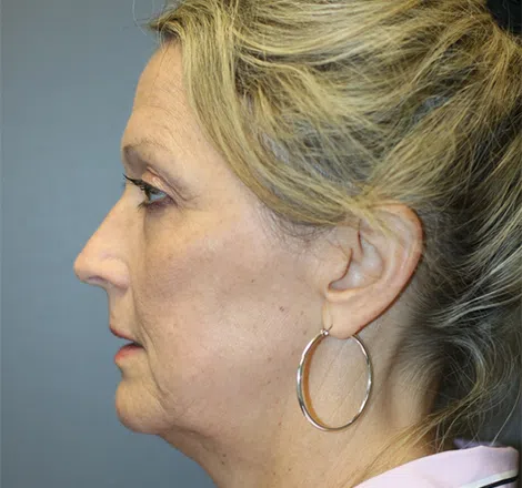 Before FLPatient01 Left Atlanta Plastic Surgery - Top Doctor by Atlanta Magazine