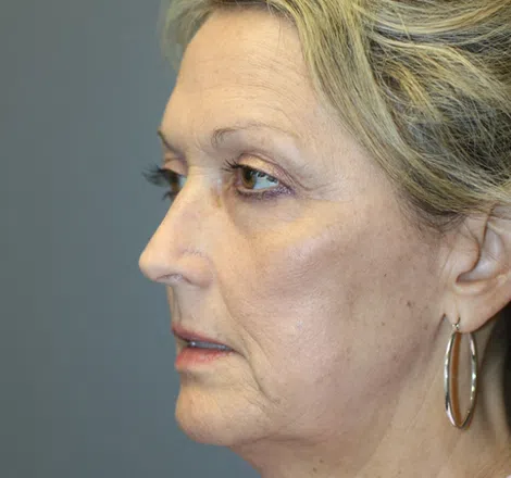 Before FLPatient01 LeftAngle Atlanta Plastic Surgery - Top Doctor by Atlanta Magazine