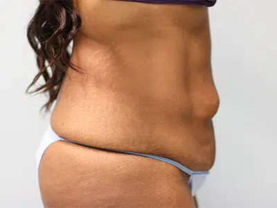 Before Patient01 Right Atlanta Plastic Surgery - Top Doctor by Atlanta Magazine