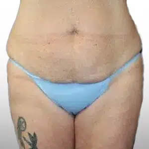 Before Patient02 Front Atlanta Plastic Surgery - Top Doctor by Atlanta Magazine