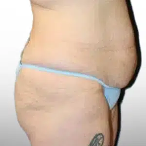 Before Patient02 Right Atlanta Plastic Surgery - Top Doctor by Atlanta Magazine