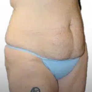 Before Patient02 RightAngle Atlanta Plastic Surgery - Top Doctor by Atlanta Magazine