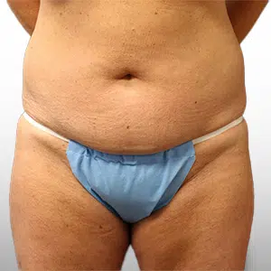 Before Patient03 Front Atlanta Plastic Surgery - Top Doctor by Atlanta Magazine