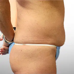 Before Patient03 Right Atlanta Plastic Surgery - Top Doctor by Atlanta Magazine