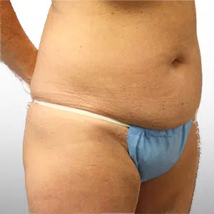 Before Patient03 RightAngle Atlanta Plastic Surgery - Top Doctor by Atlanta Magazine