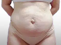 Before Patient04 Front Atlanta Plastic Surgery - Top Doctor by Atlanta Magazine