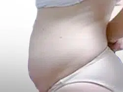 Before Patient04 Left Atlanta Plastic Surgery - Top Doctor by Atlanta Magazine