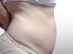 Before Patient04 Right Atlanta Plastic Surgery - Top Doctor by Atlanta Magazine