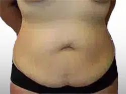 Before Patient05 Front Atlanta Plastic Surgery - Top Doctor by Atlanta Magazine