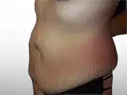 Before Patient05 Left Atlanta Plastic Surgery - Top Doctor by Atlanta Magazine