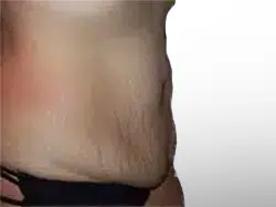 Before Patient05 Right Atlanta Plastic Surgery - Top Doctor by Atlanta Magazine