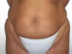 Before Patient06 Front Atlanta Plastic Surgery - Top Doctor by Atlanta Magazine