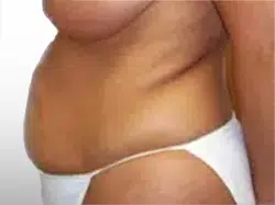 Before Patient06 Left Atlanta Plastic Surgery - Top Doctor by Atlanta Magazine