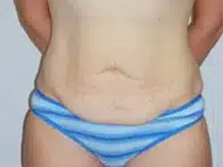 Before Patient07 Front Atlanta Plastic Surgery - Top Doctor by Atlanta Magazine