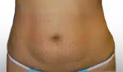 Before Patient08 Front Atlanta Plastic Surgery - Top Doctor by Atlanta Magazine