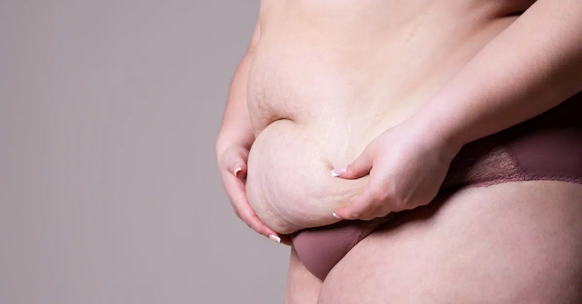 Woman considering a tummy tuck in Atlanta and combination treatments