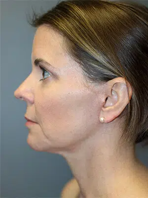 After 01 51 Atlanta Plastic Surgery - Top Doctor by Atlanta Magazine