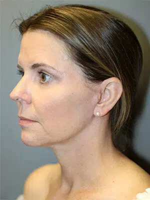 After 02 51 Atlanta Plastic Surgery - Top Doctor by Atlanta Magazine