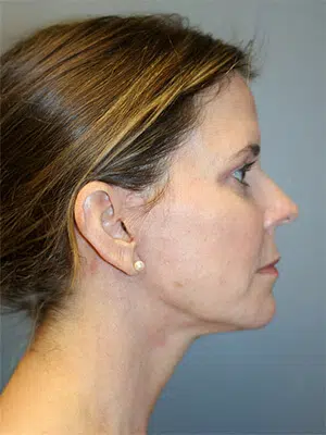 After 03 51 Atlanta Plastic Surgery - Top Doctor by Atlanta Magazine