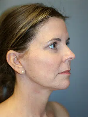 After 04 51 Atlanta Plastic Surgery - Top Doctor by Atlanta Magazine