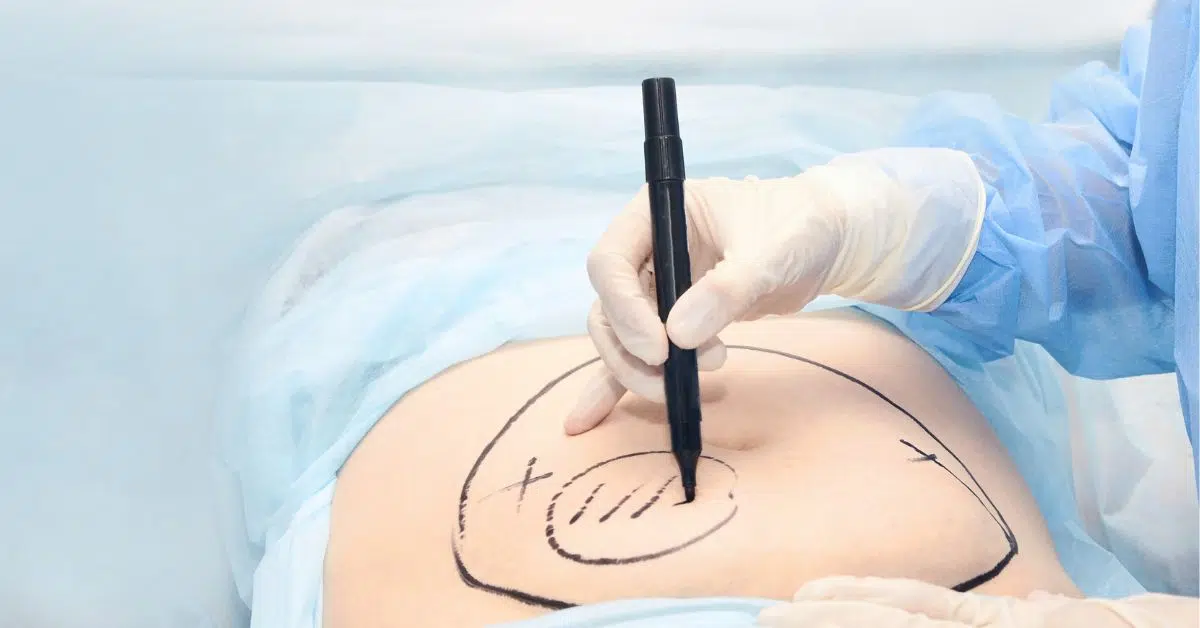 plastic surgery cosmetic surgeon marking areas in preparation for the procedure