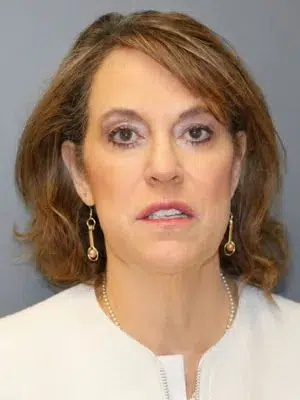 Neck lift with submental liposuction 1