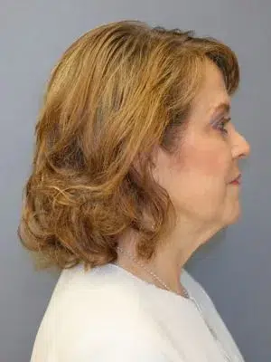 Neck lift with submental liposuction 2