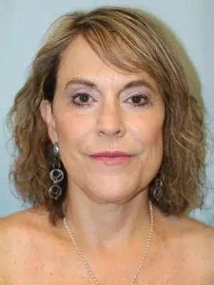 Neck lift with submental liposuction 6
