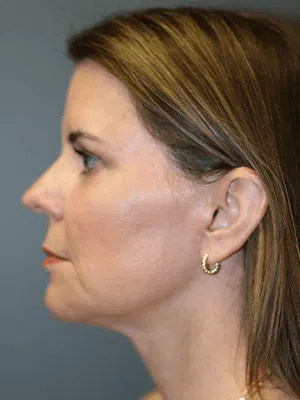 PPS_NeckLiftPatient_01