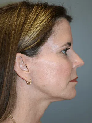 PPS_NeckLiftPatient_03