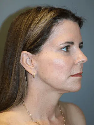PPS_NeckLiftPatient_04